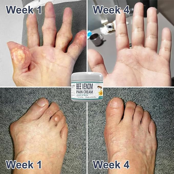 NZ Bee Venom Joint and Bone Therapy Cream New Zealand Bee Venon For Pain